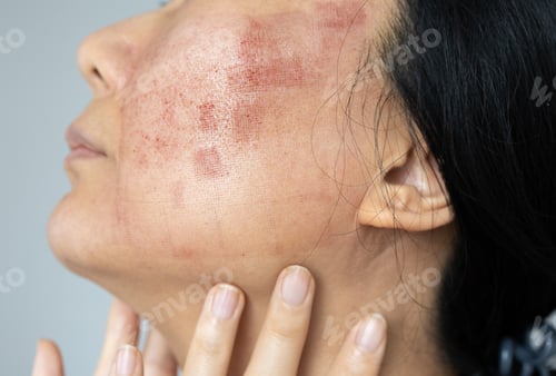 Preview: A face of Asian woman who had facial skin treatment by Co2 laser to treat her Acne Scars to get face