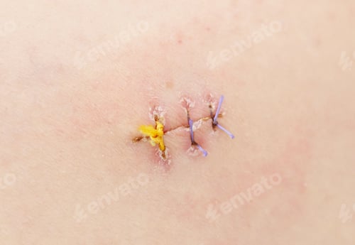 Preview: Stitched up skin after laparoscopic operation