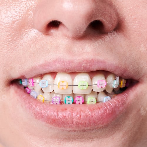 Preview: Macro snapshot of white teeth and ceramic braces with colorful rubber bands on them