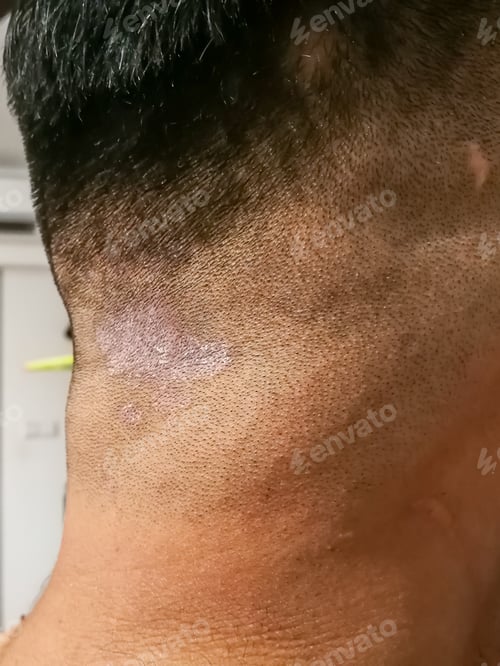 Preview: Closed up of ringworm also known as tinea on the scalp of the head. Dermatitis problem.