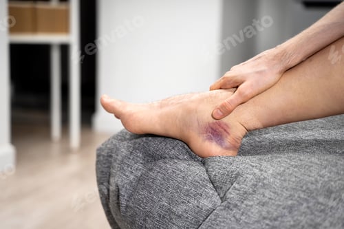 Preview: Man hand holding painful ankle with dark bruise and swelling after injury