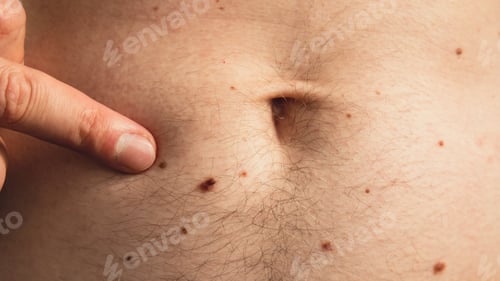 Preview: Male hand showing birthmarks on skin body stomach part. Close up detail of the bare skin. Health