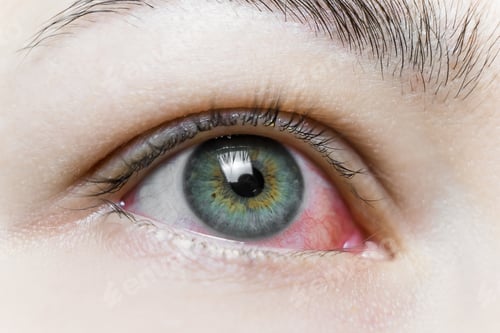 Preview: Close up of a severe bloodshot red eye. Viral Blepharitis, Conjunctivitis, Adenoviruses. Irritated