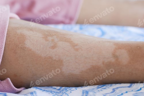Preview: feet with vitiligo skin condition.