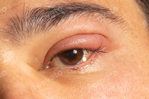 Preview: Inflamed eye with infected stye, upper eyelid, ophthalmic medicine.