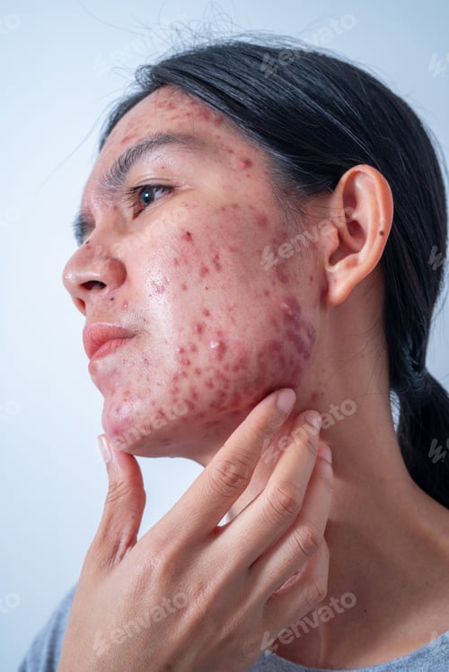 Preview: Acne on face because the disorders of sebaceous glands productions. Acne or a Cosmetic Allergy.