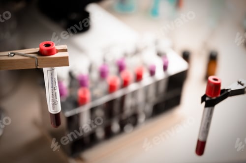 Preview: COVID-19 test and laboratory sample of blood testing for diagnosis new Corona virus