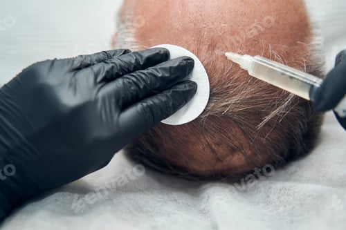 Preview: Man receiving injection for hair growth in cosmetology clinic