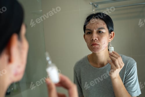 Preview: Acne on face because the disorders of sebaceous glands productions. Acne or a Cosmetic