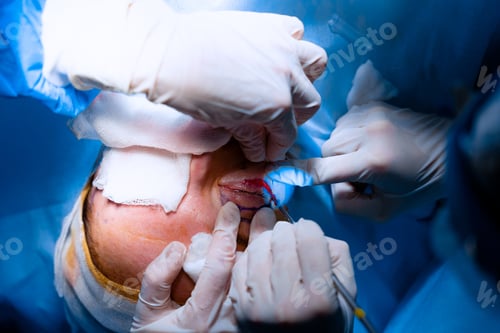 Preview: Surgeons correct eyelid shape with blepharoplasty