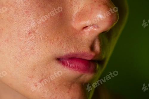 Preview: post-acne, scars and red festering pimples on the face of a young woman.