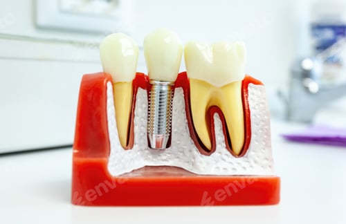 Preview: Dental implant being inserted into anatomical model of teeth and gums