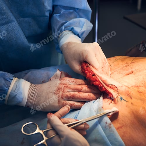Preview: Medical workers performing abdominoplasty surgery in clinic.