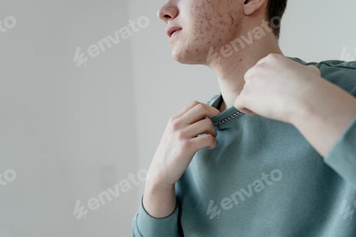 Preview: a guy in a turquoise sweater with problem skin on his face, acne, a teenager in transitional age