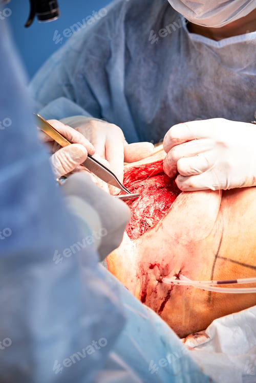 Preview: The doctor performs an operation to reconstruct the female breast. Close-up of plastic surgeon
