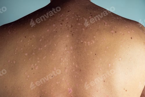 Preview: Close-up of red inflamed skin of back with blemishes of unrecognizable man suffering from psoriasis