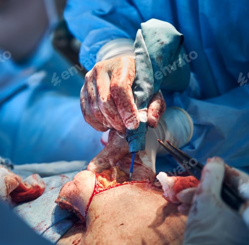 Preview: Plastic surgeon performing abdominoplasty surgery in clinic.