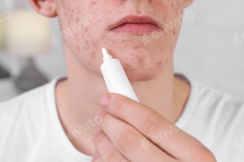 Preview: Young man with acne problem applying cosmetic product onto his skin indoors, closeup