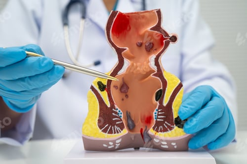 Preview: Asian doctor with rectum and hemorrhoid human anatomy model