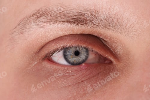 Preview: Macro shot of a human eye with purulent inflammation of barley. Hordeolum.