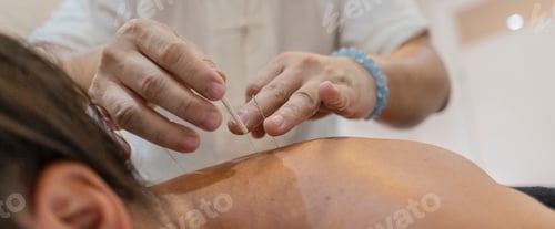 Preview: Acupuncturist treating patient with thin acupuncture needles