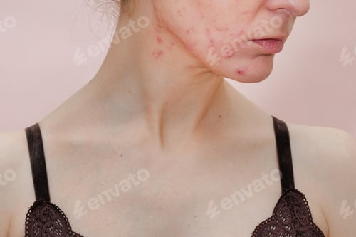 Preview: Woman With Problem Skin. Teen Acne On Young Skin.