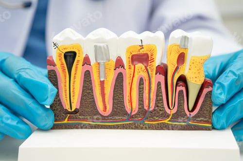 Preview: Asian dentist holding dental implant, artificial tooth roots into jaw, root canal