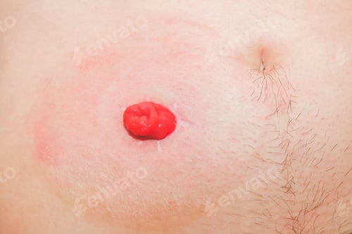 Preview: The small intestine brought out to the left on the abdomen of a young man, step 1..