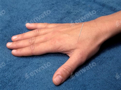 Preview: Hand with an acupuncture needle as a treatment