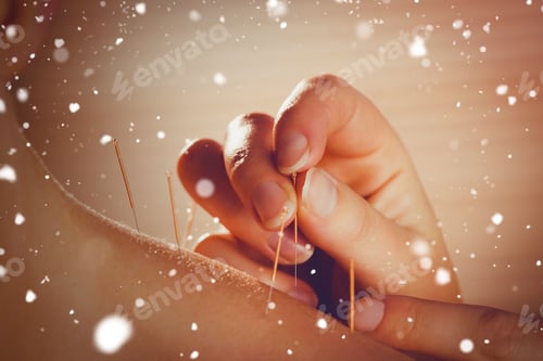 Preview: Snow Against Young Woman Getting Acupuncture Treatment