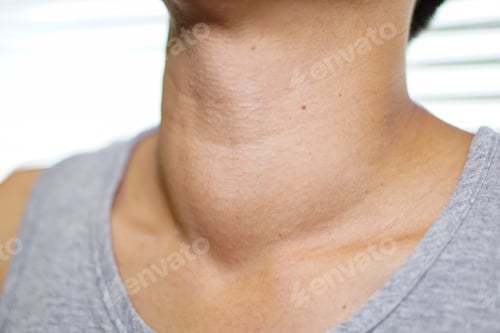 Preview: Asian lady woman patient have abnormal enlargement of thyroid gland Hyperthyroidism at throat.