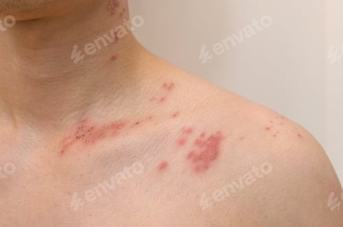 Preview: close up of man with shingles disease on skin