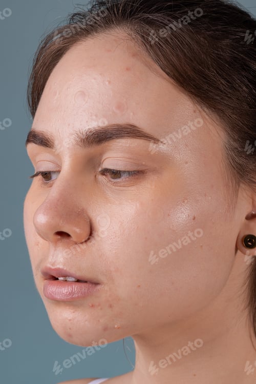 Preview: Girl with acne stick round acne patch on her cheek