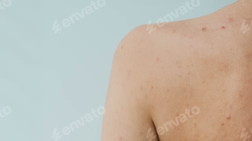 Preview: A close-up of a panoramic shot of a woman's skin prone to acne and other dermatological problems.
