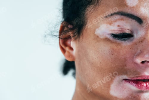 Preview: Beautiful woman with vitiligo skin