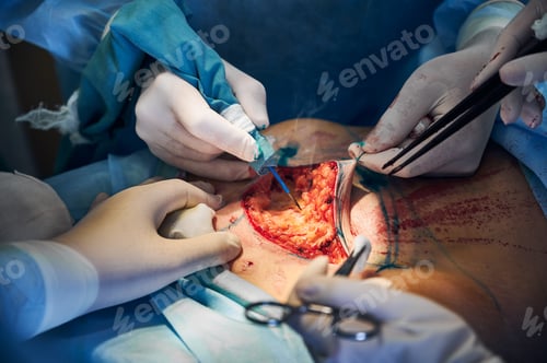Preview: Medical team doing abdominoplasty surgery in clinic.
