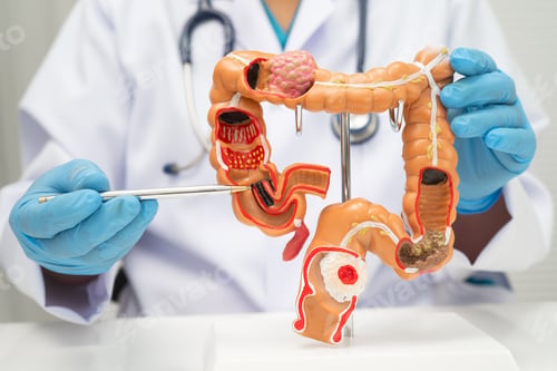 Preview: Colorectal cancer, doctor holding intestine colon human model.