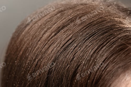 Preview: Woman with dandruff in her dark hair, closeup view