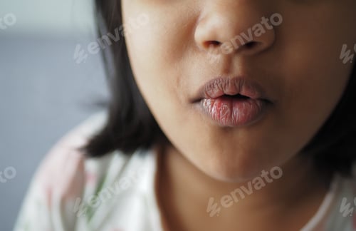 Preview: close up of dry lip of a child