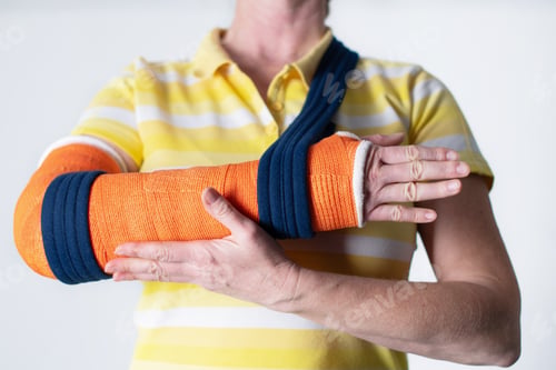 Preview: woman with broken right arm in Fiberglass casts to hold broken bones in place until they heal,modern