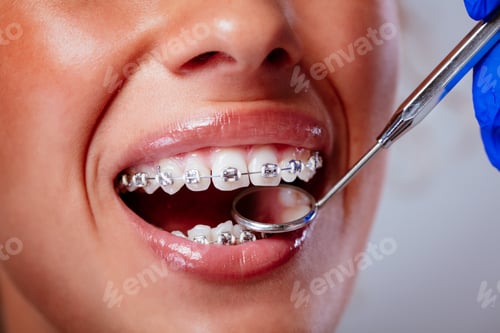 Preview: Checking Braces