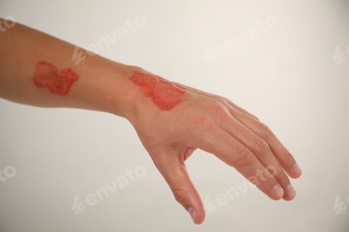 Preview: Man with burned hand on light grey background, closeup