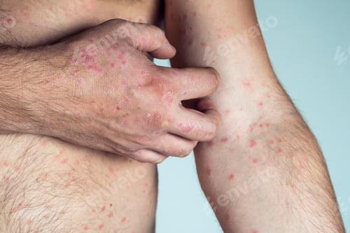 Preview: Cropped photo of half-naked man suffering from psoriasis scratching thick scaly clusters rash on ski