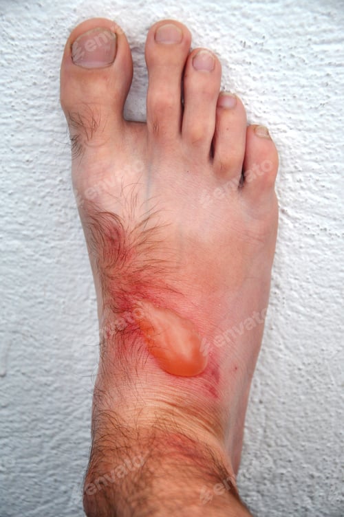 Preview: Phytophotodermatitis, cutaneous phototoxic skin inflammatory eruption