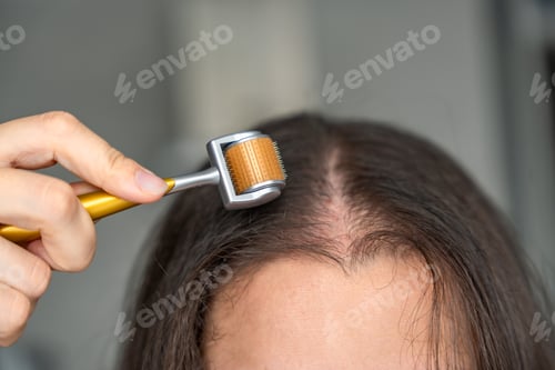Preview: Close up view of young woman using microneedle derma roller on head for stimulating new hair growth