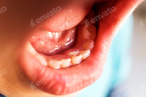 Preview: Children shark teeth, first tooth that appears in childhood behind baby teeth.