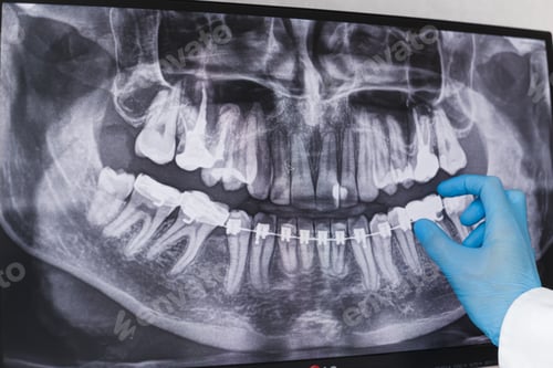 Preview: Doctor points to braces in dental x-ray