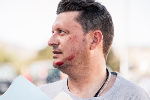Preview: Man skateboarder with face injury after falling with his skateboard.
