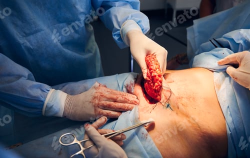 Preview: Medical workers performing abdominoplasty surgery in clinic.