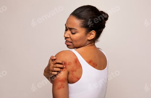 Preview: Black woman scratching red spots on her skin